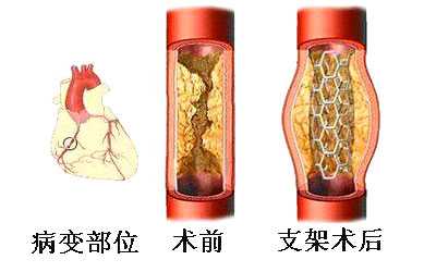 心脏支架术后多久可以旅游-心脏支架后多久可以做家务